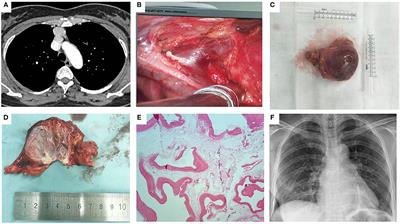Case Report: Surgical Therapy for Left Innominate Vein Aneurysm Under Thoracoscopy